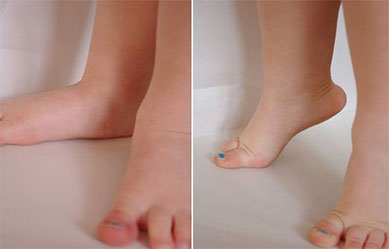 Flexible Flatfoot Treatment in Children